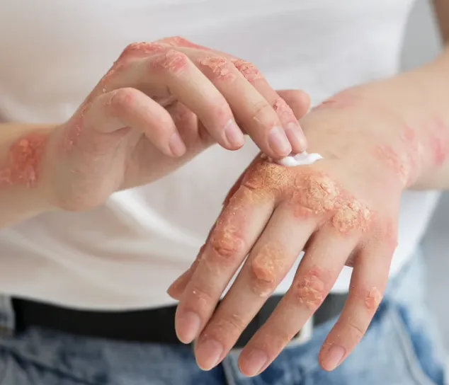 Alerta por casos de lepra en Guanajuato