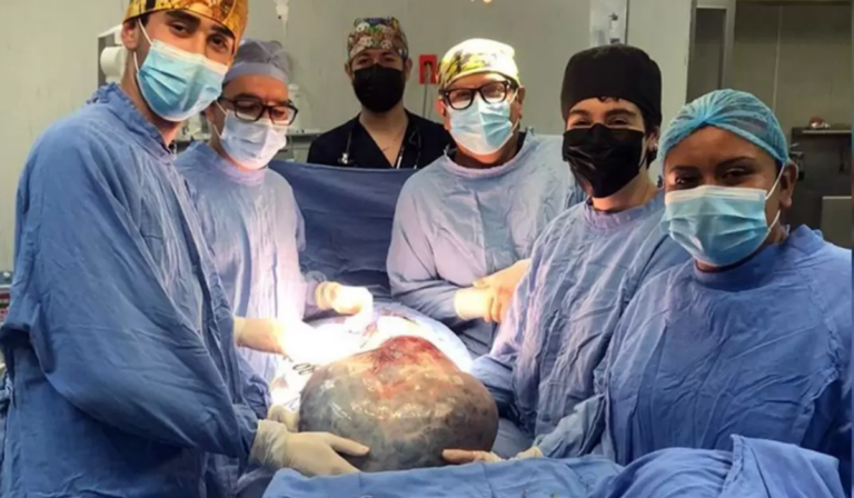 Retiran tumor gigante de 21 Kilogramos en IMSS de León, Guanajuato