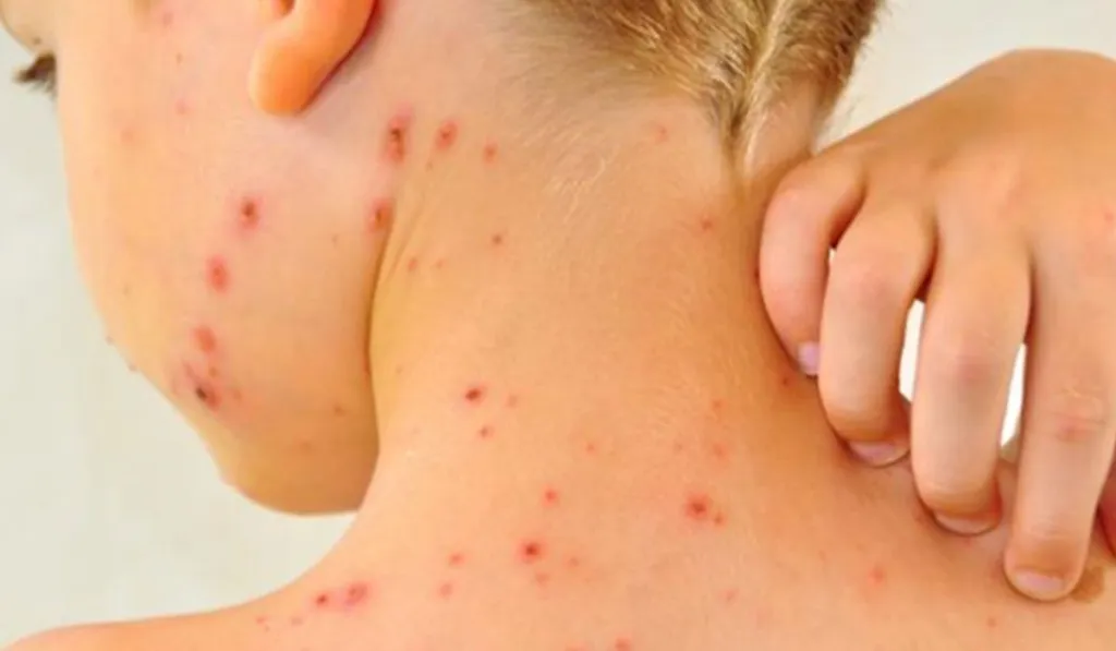 SEP suspende clases en Jalisco y Aguascalientes por brote de sarampión